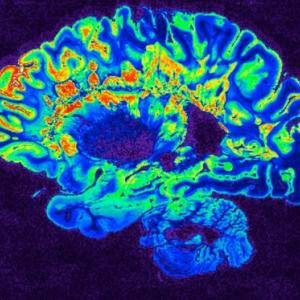 NIH Brain Scan Image