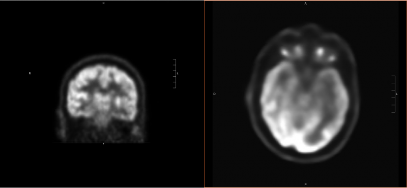 brain pet scan epilepsy